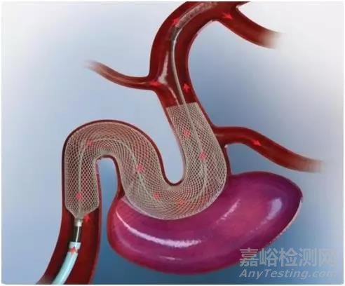 FDA又批准一款治疗动脉瘤的支架