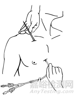 长期血液透析导管技术特点