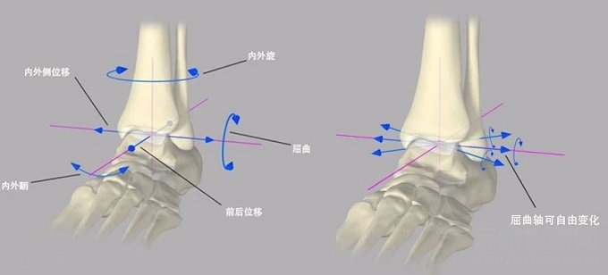 【医疗器械】人工踝关节假体设计
