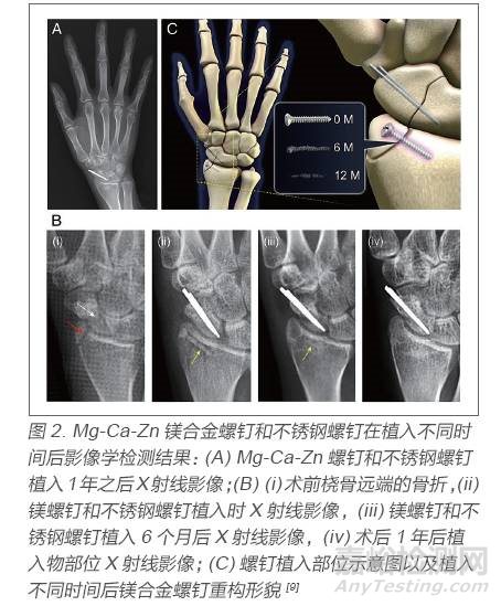 医用金属材料研发与应用进展