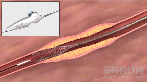 我国首个外周药物洗脱支架获批上市