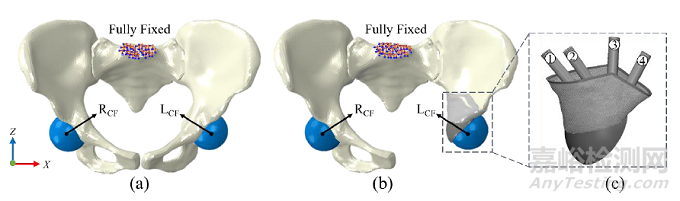 骨盆个性化重建的生物力学分析