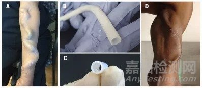 Science综述：人造血管