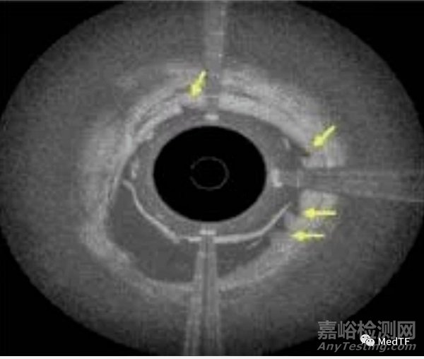 FLEX Vessel Prep：获批用于治疗血管支架内再狭窄