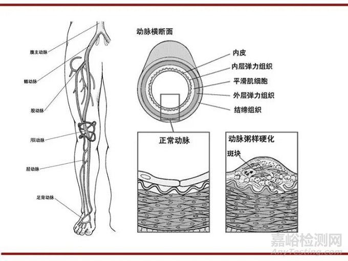 FDA批准上市——波士顿科学Ranger™ 紫杉醇药物洗脱球囊介绍