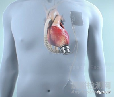 Corvion LVAD：首个完全植入LVAD的优势介绍