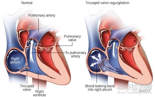 TricValve：首个上下腔静脉植入瓣膜治疗三尖瓣关闭不全