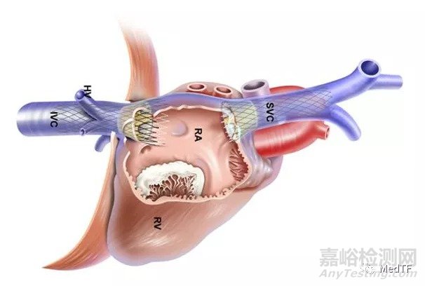 TricValve：首个上下腔静脉植入瓣膜治疗三尖瓣关闭不全