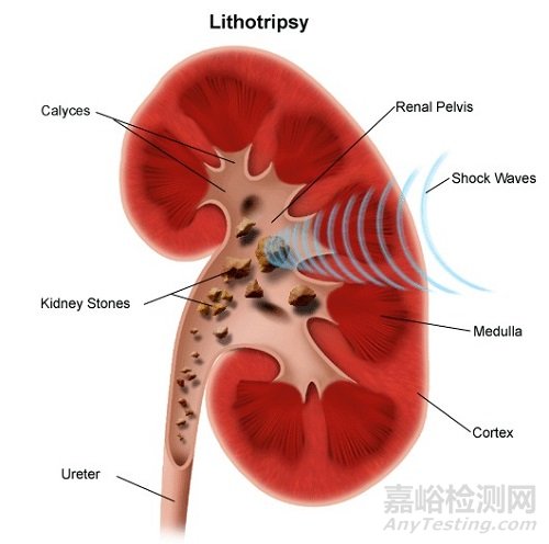 冲击波球囊及其在血管领域的技术要点