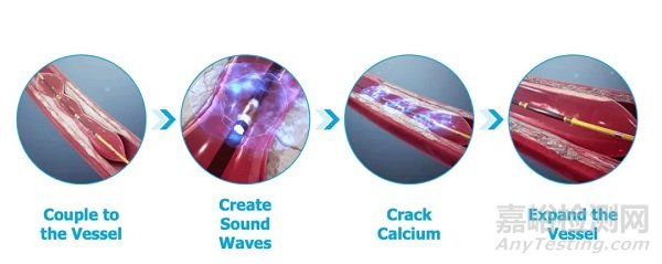 冲击波球囊及其在血管领域的技术要点