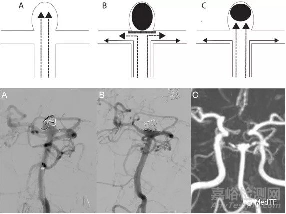 eCLIPs：类蜈蚣似的动脉瘤治疗器械