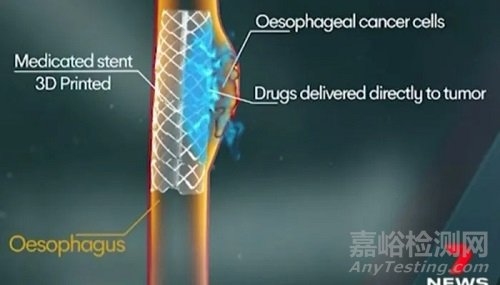 世界首个3D打印食道支架的技术及材料分析