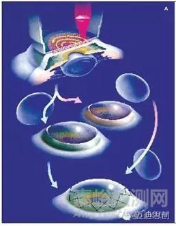国产人工角膜6月用于临床，超全的人工角膜研发科普贴