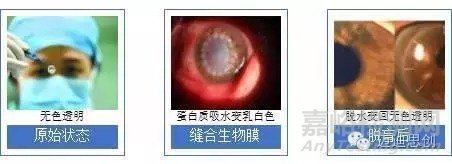 国产人工角膜6月用于临床，超全的人工角膜研发科普贴