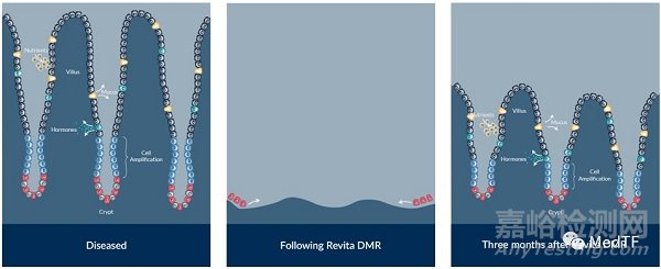 Revita：2型糖尿病治疗新技术