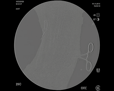 VenoValve：有望解决下肢慢性静脉功能不全患者长期困扰