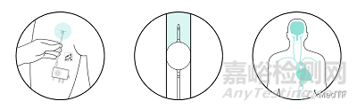 【创新医械】Neurescue Device：有望大幅提高心脏骤停患者生存率