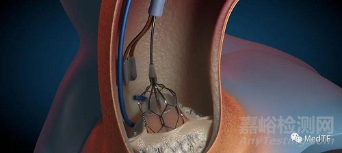 GEMINI：主动脉瓣双频率超声除钙技术