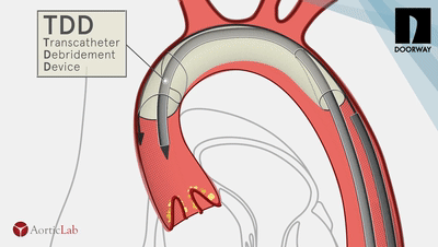 GEMINI：主动脉瓣双频率超声除钙技术