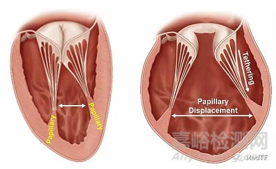 V-sling：经导管左心室乳头肌修复治疗心衰