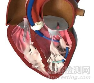 V-sling：经导管左心室乳头肌修复治疗心衰