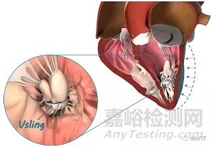 V-sling：经导管左心室乳头肌修复治疗心衰