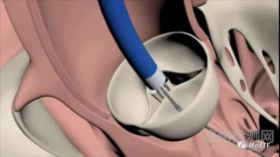 心脏瓣膜关闭不全问题的解决方案