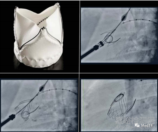 Xeltis PV极有可能重新定义心脏瓣膜