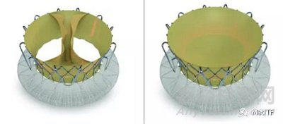 TRISOL VALVE：整体式瓣叶的三尖瓣