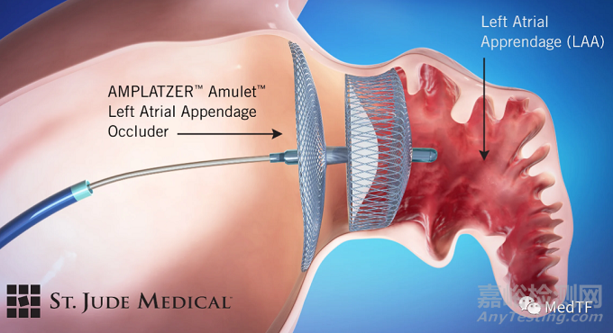 Amplatzer Amulet ：第二款左心耳封堵器获FDA批准上市