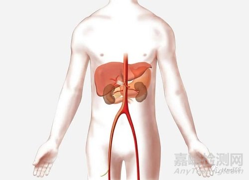 iRF Denervation消融导管：肝总动脉去交感神经治疗高血压