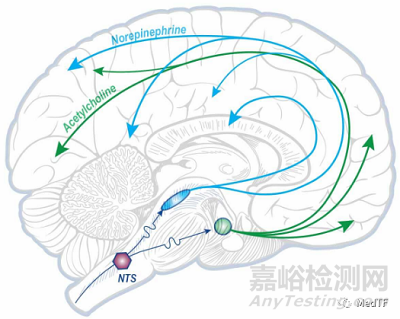 Vivistim：FDA 批准首个中风康复器械---迷走神经刺激