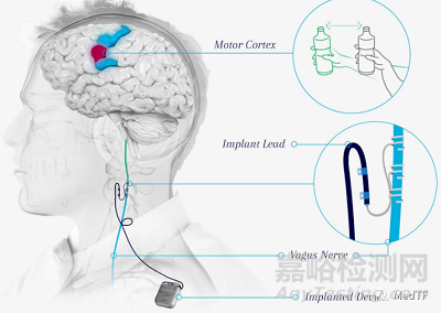 Vivistim：FDA 批准首个中风康复器械---迷走神经刺激