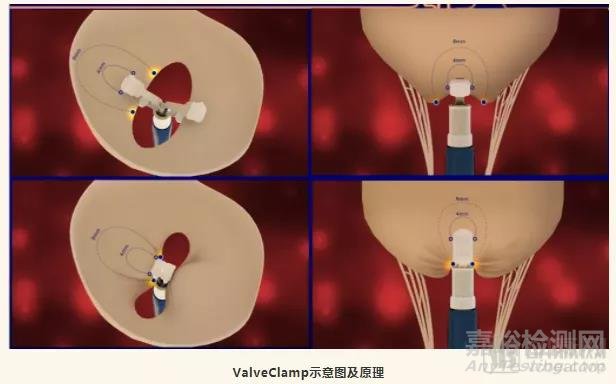 ValveClamp 完成10例功能性二尖瓣反流探索性临床研究