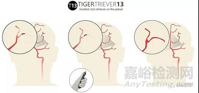 TIGERTRIEVER13：最小取栓支架 开启脑远端区域卒中治疗