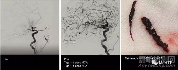 TIGERTRIEVER13：最小取栓支架 开启脑远端区域卒中治疗