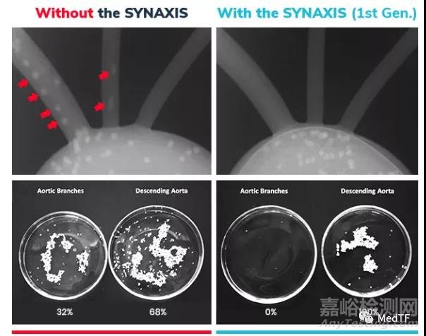 SYNAXIS：主动脉弓过滤器 开启全新中风预防理念