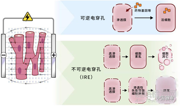 不可逆电穿孔技术IRE的发展及临床应用