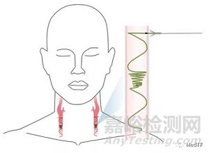 Vine：螺旋型过滤器 预防中风