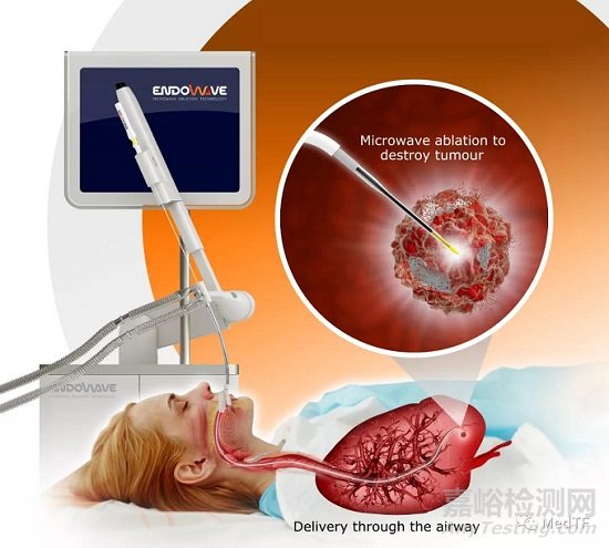 Endowave System：柔性微波消融导管 经支气管治疗肺癌