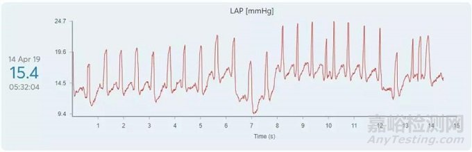 V-LAP：世界上首台心内微型计算机 实时监测心衰