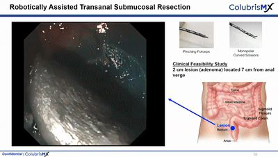 Endoluminal Surgical：消化内科软体机器人