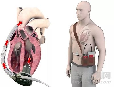 FiVAD：无线心室辅助装置 完成临床前研究