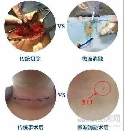 外科能量医疗器械技术全面解读