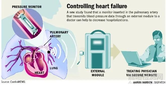 CardioMEMS：FDA批准用于 II 级心衰患者
