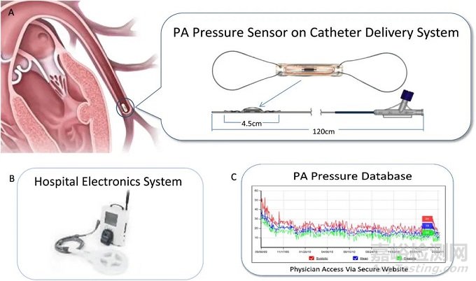 CardioMEMS：FDA批准用于 II 级心衰患者