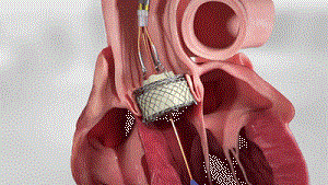 可回收的适用于反流的TAVR