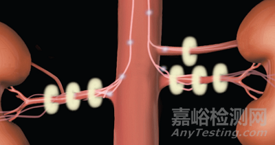 肾动脉消融器械技术解析