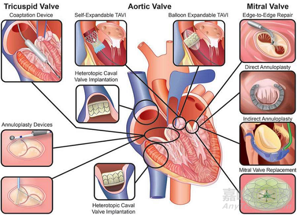 心脏瓣膜之二尖瓣技术解析