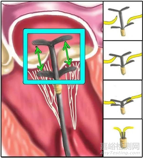心脏瓣膜之二尖瓣技术解析
